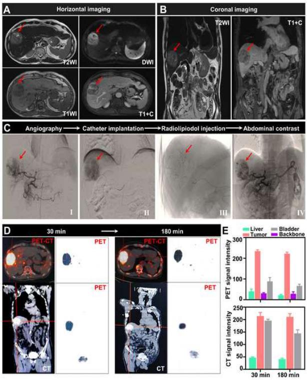 我国专家研究治疗复发难治性肝癌取得进展