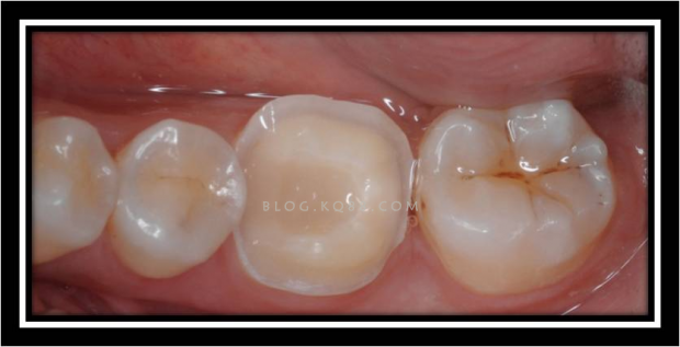 正海生物发布海奥3D钙硅生物陶瓷口腔骨修复材料